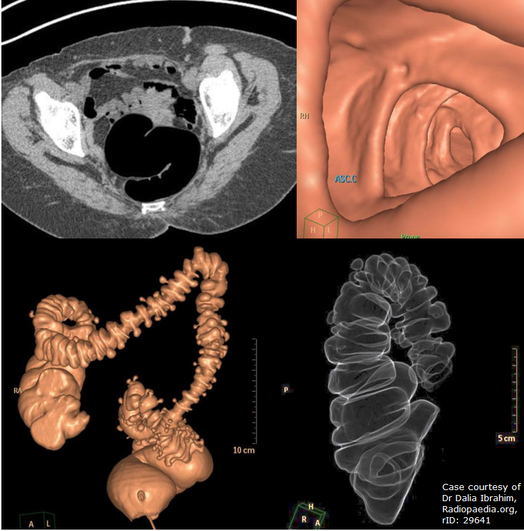 CT Colonography